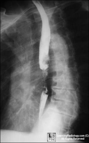 Ca of esophagus